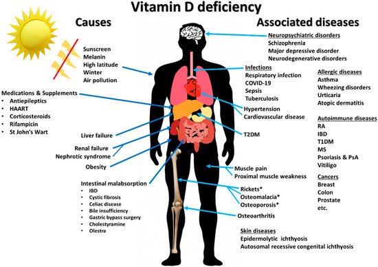 “Breve relatório: Deficiência de vitamina D em SARS-CoV-2 induzida por ARDS” * “Brief Report: Vitamin D deficiency in SARS-CoV-2-induced ARDS” * “Os níveis de vitamina D estão inversamente associados às síndromes virais respiratórias superiores clinicamente aparentes, bem como à ARDS, devido aos seus efeitos na modulação da resposta imune. A vitamina D foi estabelecida como moderando a inflamação, promovendo a atividade das células T reguladoras, aumentando a liberação de IL-10 e inibindo a liberação de interleucina-6 (IL-6) de subconjuntos de células inflamatórias.”